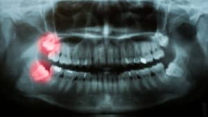 wisdom teeth in x-ray